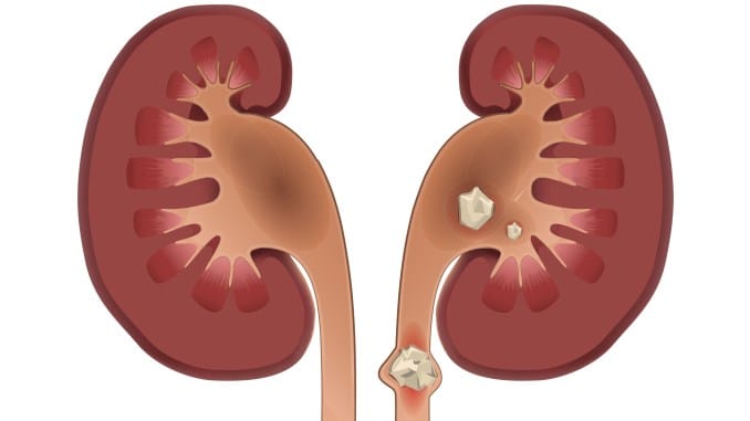 Tudo Que Voce Deveria Saber Sobre Pedra Nos Rins Mas Nao Sabe