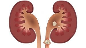 Vejas as respostas para as dúvidas mais comuns sobre pedras nos rins