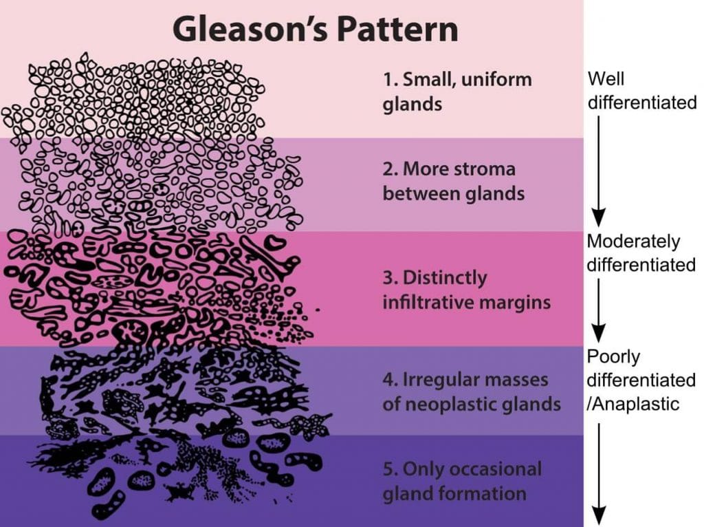 Entenda a escala de gleason