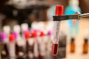 Teste Sanguíneo pode prever a sobrevivência com o câncer de próstata metastático