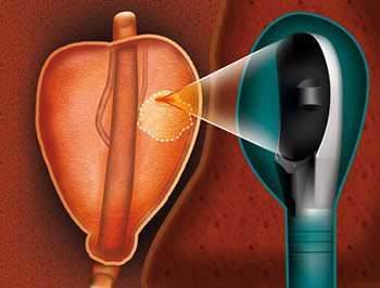 Esquema de como funciona o método de tratamento HIFU para câncer de próstata